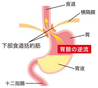 逆流性食道炎